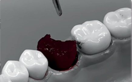 O THE GraftTM Collagen é composto de 90% matriz mineral óssea porcina de origem trabecular e 10% de atelocolágeno advindo do tendão porcino.