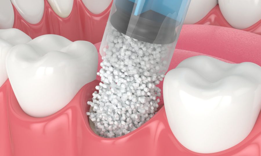enxerto ósseo dentário