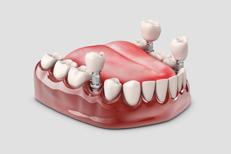 Periimplantite