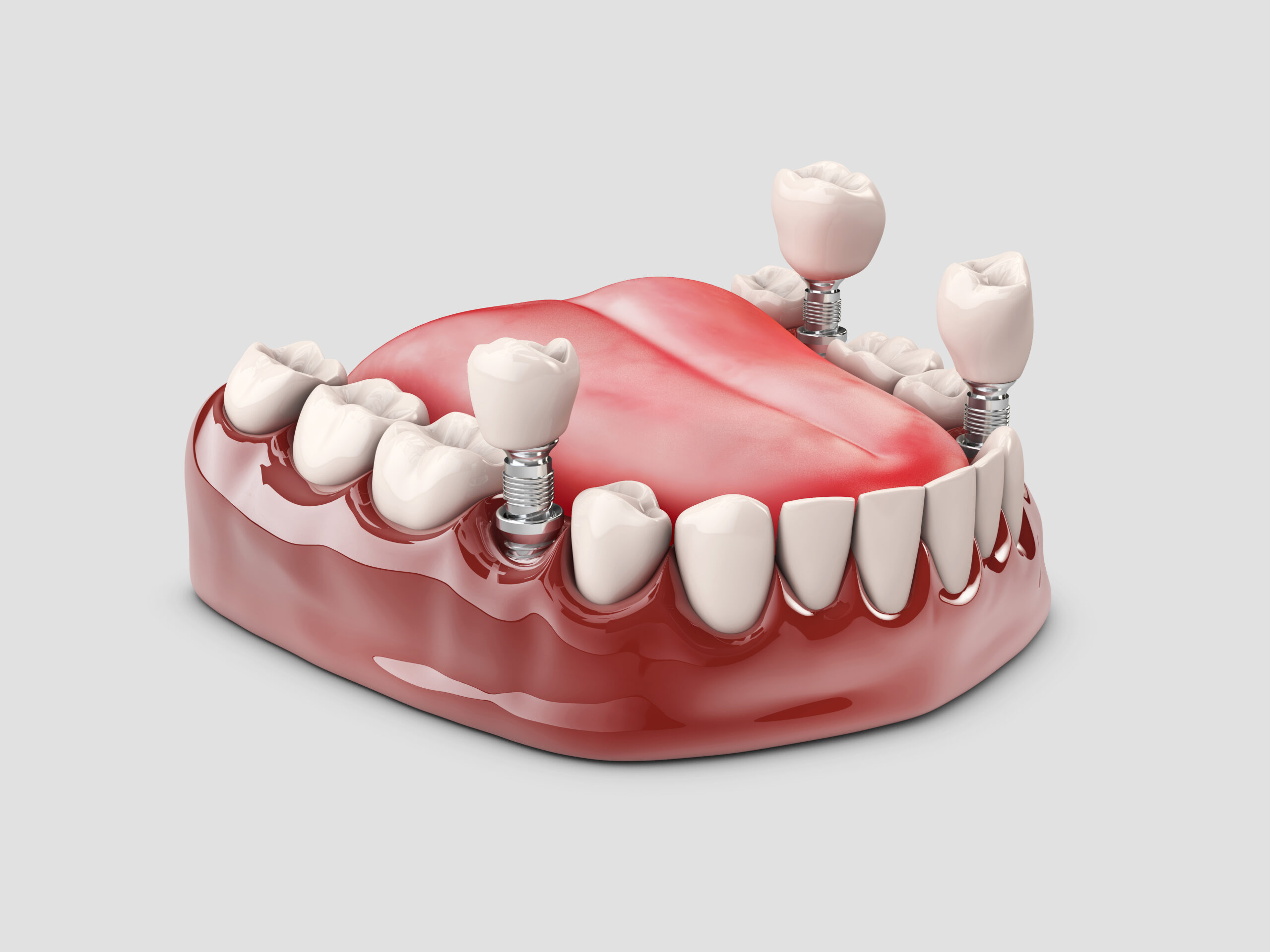 Periimplantite