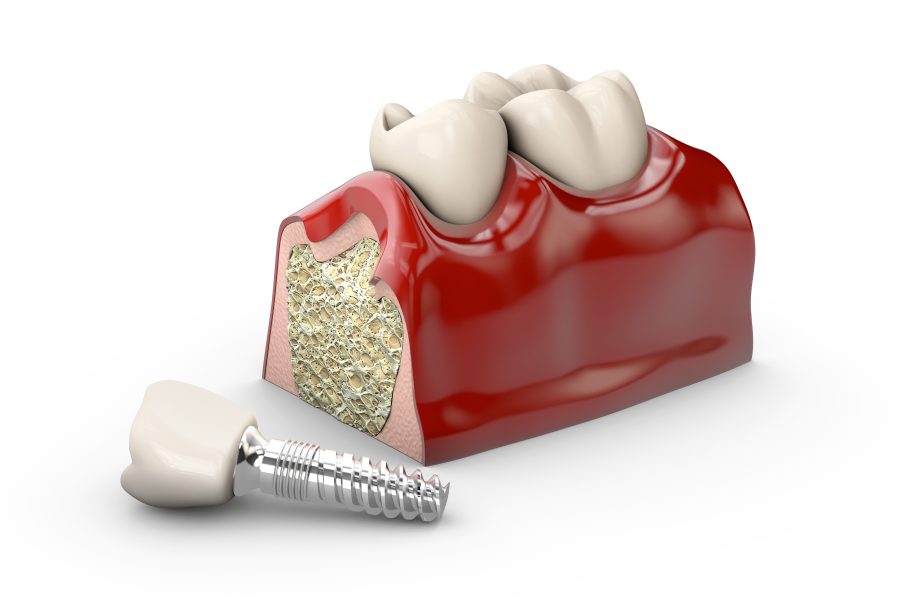 instalação de implante dentário