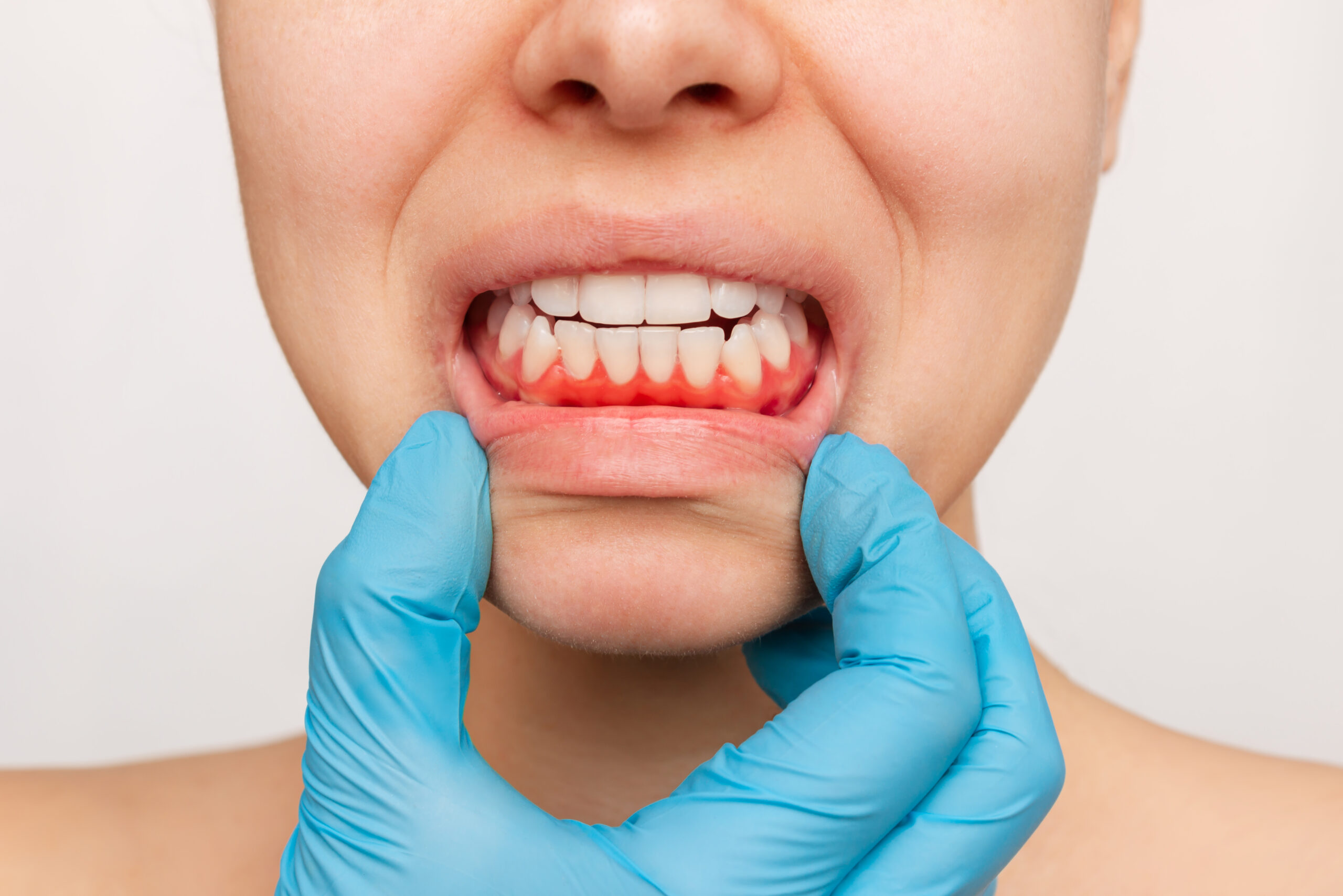 dentista analisando gengiva inflamada