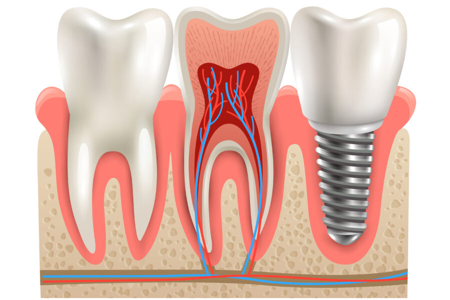 Implante dentário e anatomia real do dente em close, seção cortada, modelo, vista lateral, ilustração vetorial realista