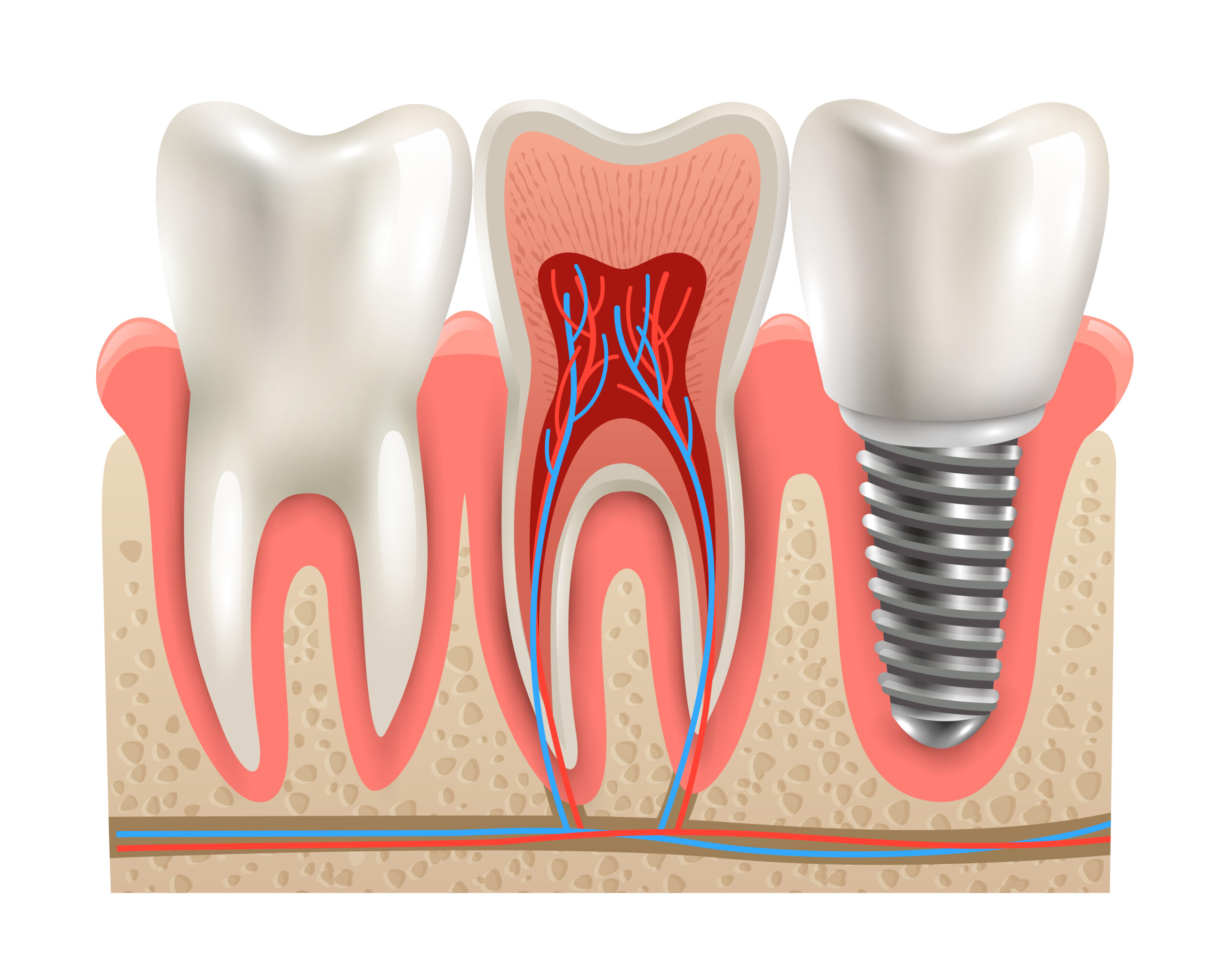 Implante dentário e anatomia real do dente em close, seção cortada, modelo, vista lateral, ilustração vetorial realista