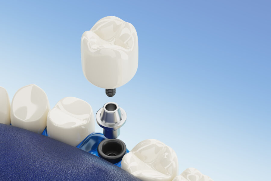 Feche o componente de implantes dentários transparente. renderização 3D.