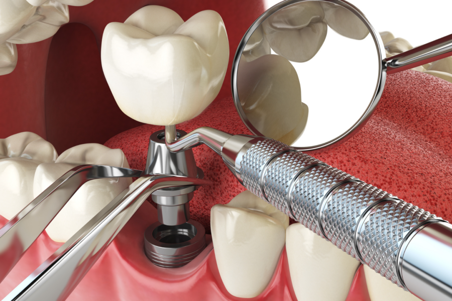 representação de um procedimento de implante dentário