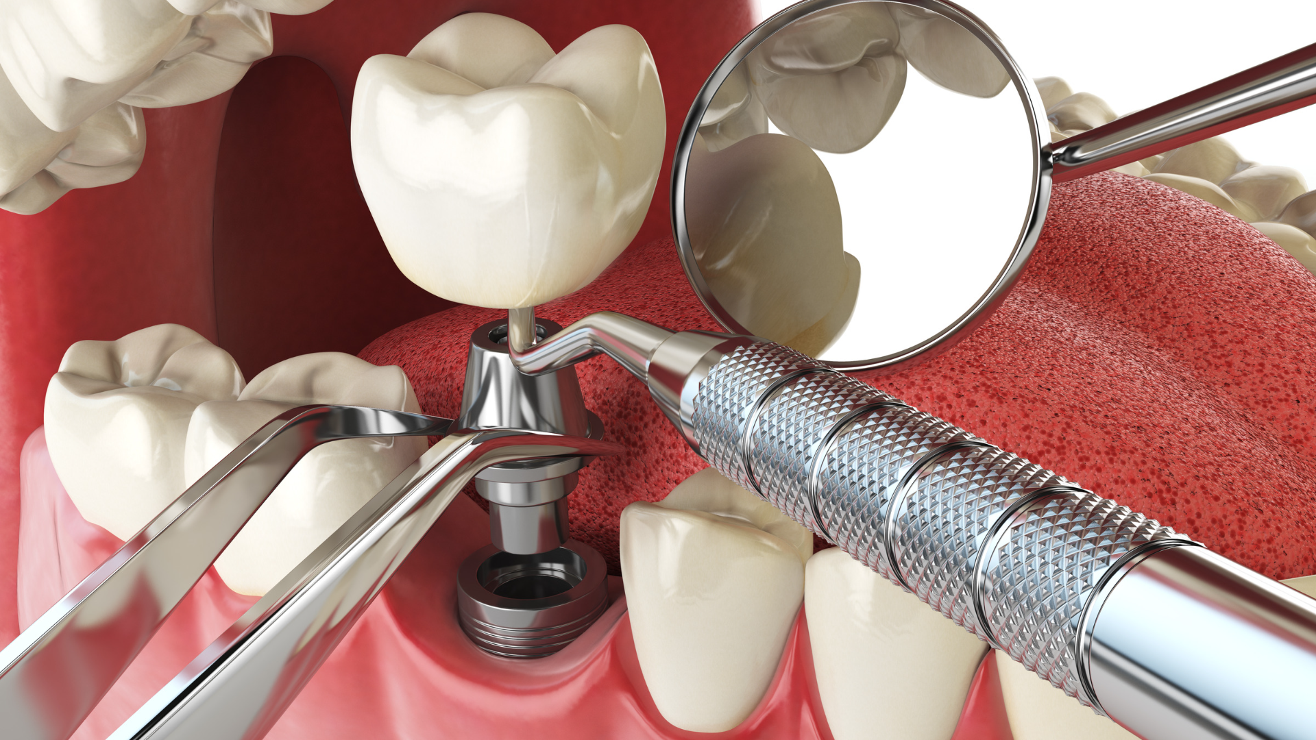 representação de um procedimento de implante dentário