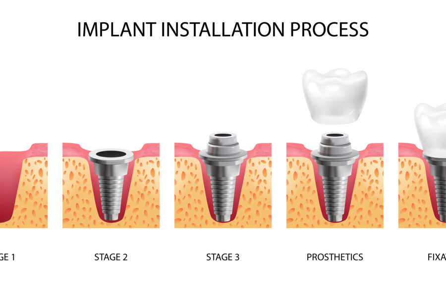 exemplo de osseointegração implante: estágios de instalação de implante dentário