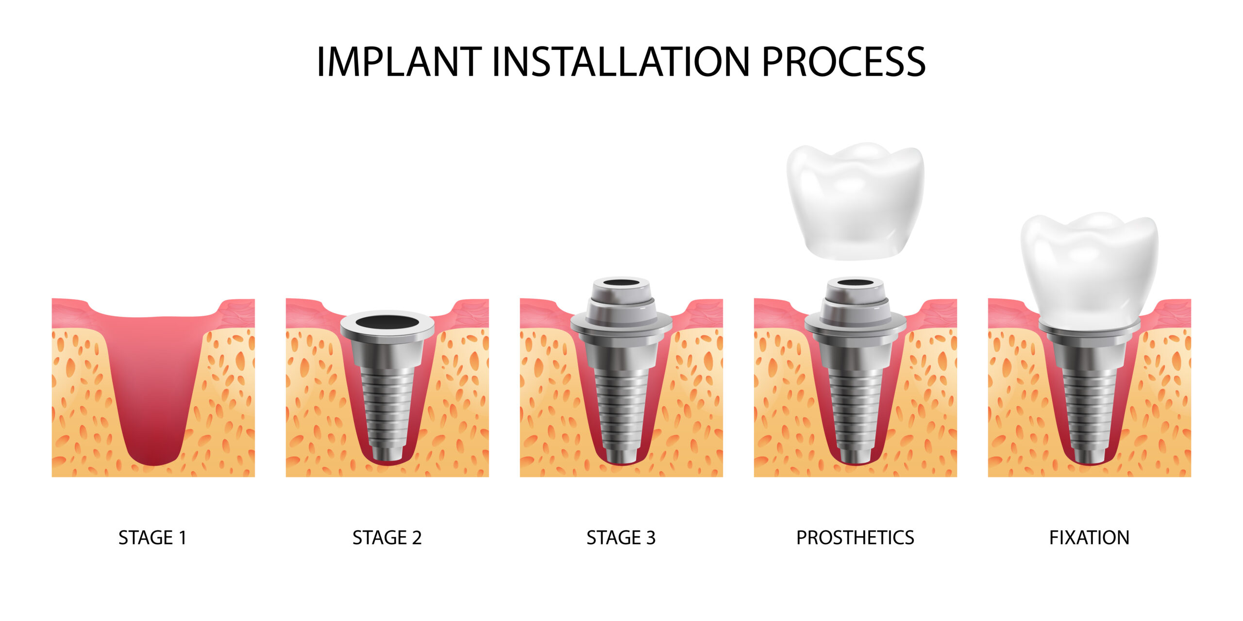 exemplo de osseointegração implante: estágios de instalação de implante dentário
