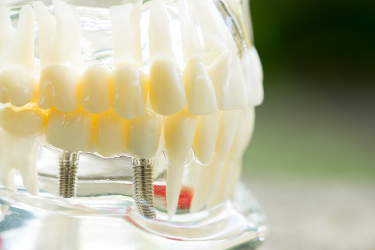 preservação alveolar