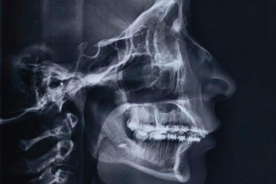 osteotomias